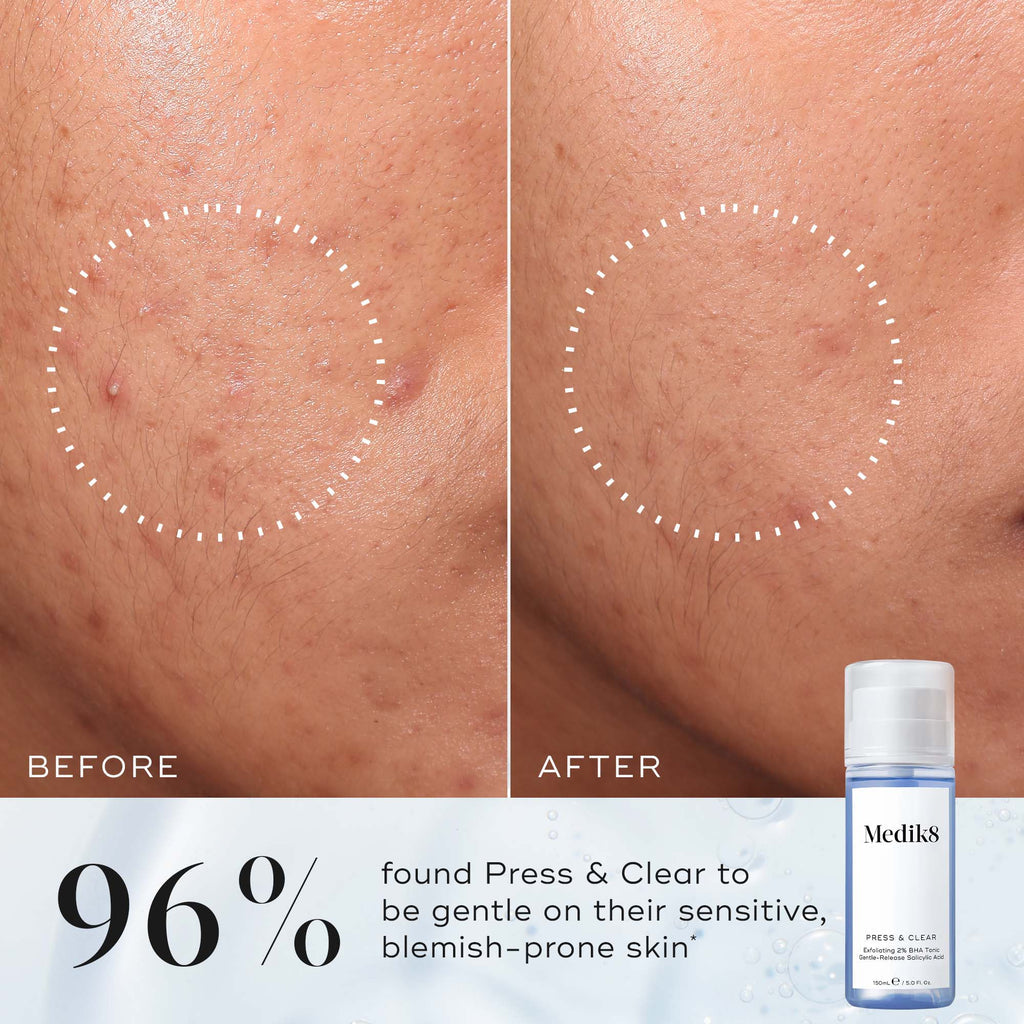 MEDIK8 PRESS & CLEAR™ 150ml
Exfoliating 2% BHA Tonic
Gentle-Release Salicylic Acid